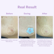 Load image into Gallery viewer, Super Flower Hydrocolloid Acne Patches